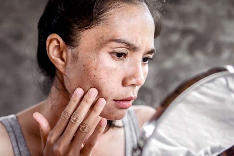 Can Hydroquinone really get rid of sun spots? - NCC.health